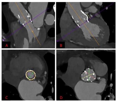 Jcm Free Full Text Transcatheter Aortic Valve Replacement In