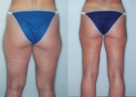 Chirurgie Cuisses Chirurgie Esthetique Turquie