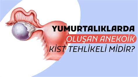 Anekoik Kist Nedir Yumurtalıklarda Oluşan Anekoik Kistler Tehlikeli