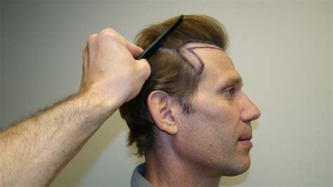 Hair Transplant Hairline At 7 Months Dr Brett Bolton Blog