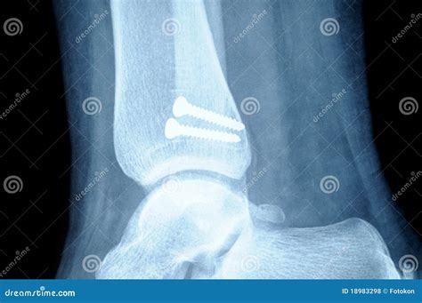 Fibula Bone Of Human On Isolated White Background Real Bone Stock