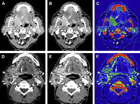 Dual Energy Computed Tomography Of The Neck Neuroimaging Clinics