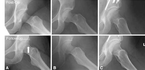 A C The Recorticalization Of The Femoral Head Neck Junction Was