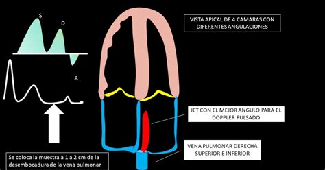 Echovar Eco Del Dia Reviviendo El Flujo Venoso Pulmonar