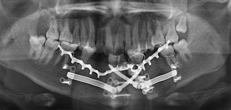 Orthopantomograph Of The Patient At The End Of The Consolidation