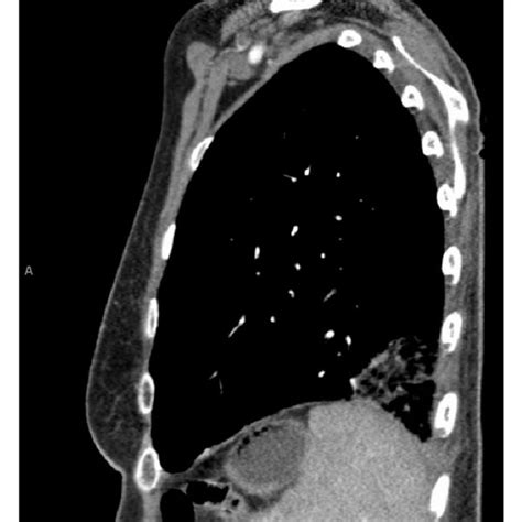 Chest CT scan of case 2 showing pulmonary embolism. | Download Scientific Diagram