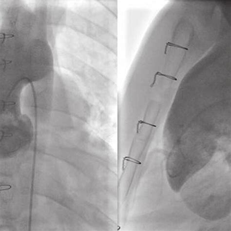 A Anteroposterior View B Lateral View Aortogram Shows A Dilated Download Scientific Diagram