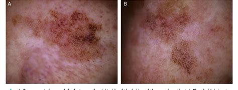 Figure 3 From Diagnostic Utility Of Dermoscopy In Pigmented Actinic