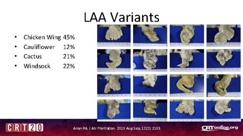 Left Atrial Appendage Closure Forum Challenging Laa Morphologies