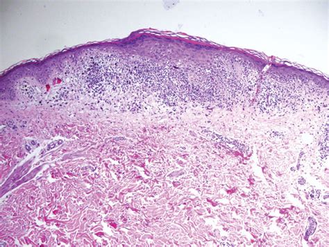 Recurrent Oral And Gluteal Cleft Erosions Mdedge Dermatology