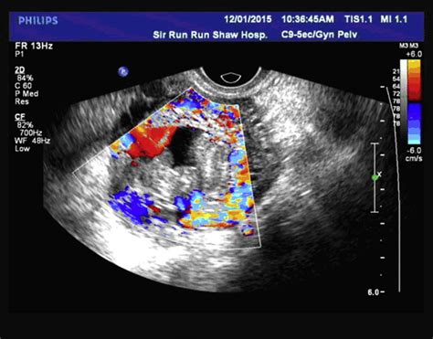 Ultrasound imaging indicated the adnexal mass. A complex adnexal mass ...