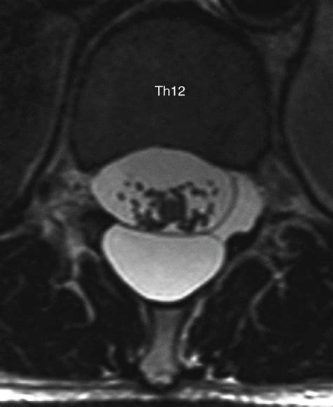 T2 Weighted Mri Showed A Cystic Lesion With T1 Low T2 High Intensity At