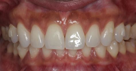 Severe Gingivitis Before And After