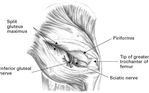 The Course Of The Inferior Gluteal Nerve In The Posterior Approach To The Hip Bone And Joint