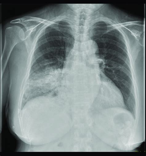 Chest Radiograph At Admission Showed Ill Defined Patchy Consolidation Download Scientific