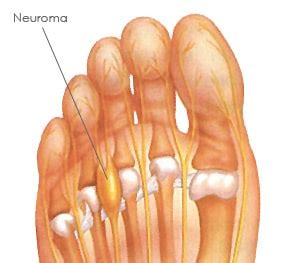 Neuroma De Morton Cl Nica Mart N G Mez Traumat Logos