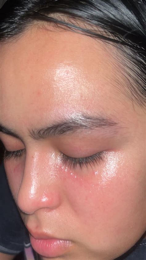 New Red Bumps Under Eyes R Skincareaddicts