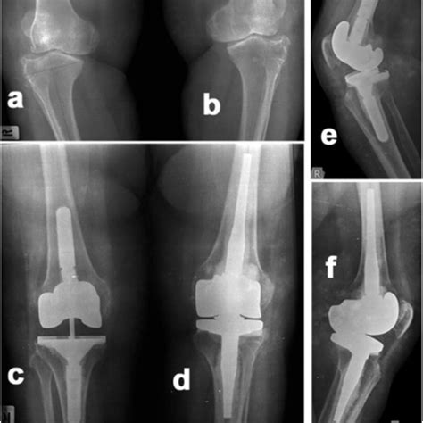 Constrained Implants In Total Knee Replacement Request Pdf