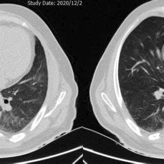 Chest High Resolution Computed Tomography Scan Without Contrast Axial