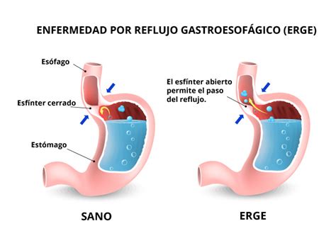 Salud And Enfermedad Aparato Digestivo Enfermedad Por Reflujo