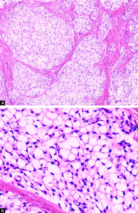 Photomicrograph Of Primary Clear Cell Odontogenic Carcinoma Lesion