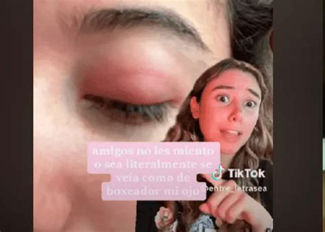 Una Joven Termina En El Hospital Por Truco De Belleza Que Vio En TikTok