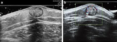 Pilomatricoma Ultrasound