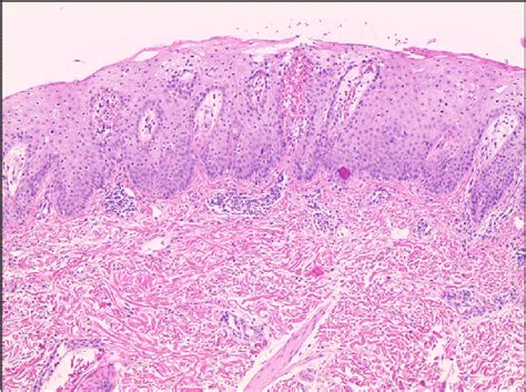 A Scalp Skin Biopsy Revealed Parakeratosis And Regular Acanthosis With