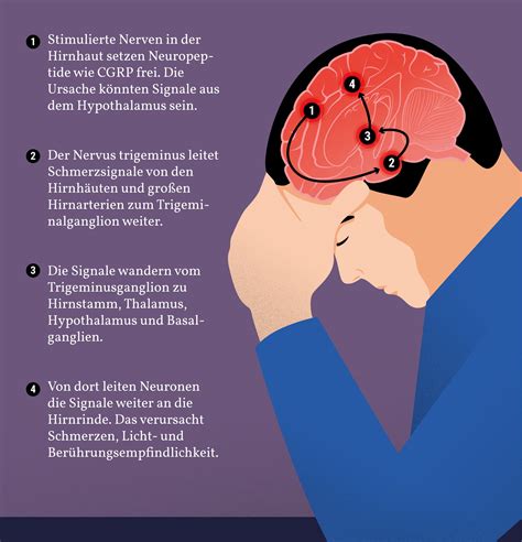 Schmerzen Was hilft gegen Migräne Spektrum der Wissenschaft