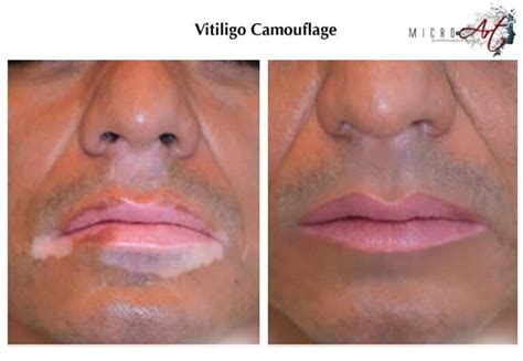 Vitiligo Treatment by MicroArt Semi Permanent Makeup