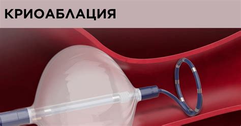 Какво е Криоаблация - Nestmar Medical