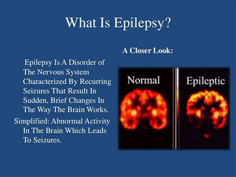 Epilepsy Presentation