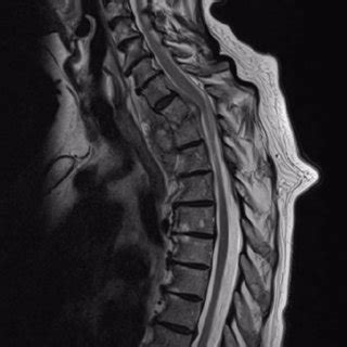 Magnetic Resonance Imaging Demonstrating T1 T2 Discitis Vertebral