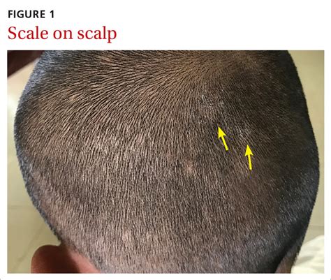 How To Fix Hair Loss Scalp At Benito Martinez Blog