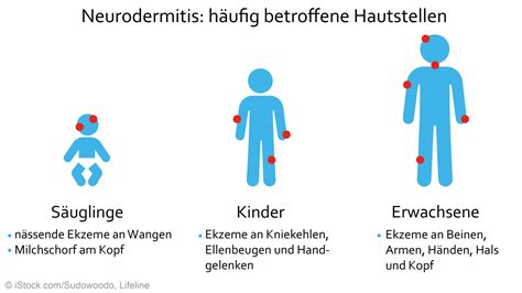 Neurodermitis In Bildern So Sieht Neurodermitis Aus