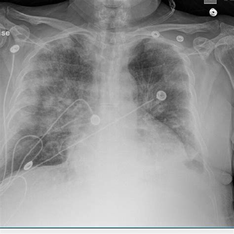 Chest X Ray Showing Bilateral Pulmonary Edema With Bilateral Patchy