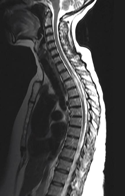 Case Report Longitudinally Extensive Transverse Myelitis Practical Neurology