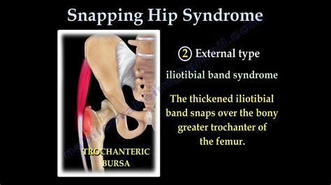 External Snapping Hip Syndrome Iliotibial Band Syndrome Hip