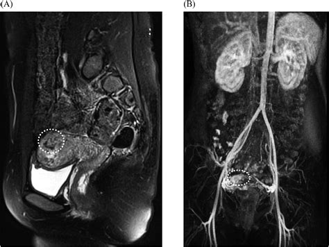 Management Of Uterine Arteriovenous Malformation Uterine Artery