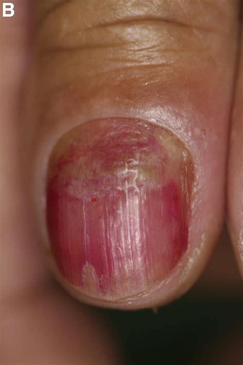 Palmoplantar Pustulosis And Acrodermatitis In A Patient Treated With