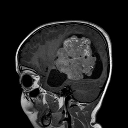 Choroid Plexus Carcinoma Image Radiopaedia Org