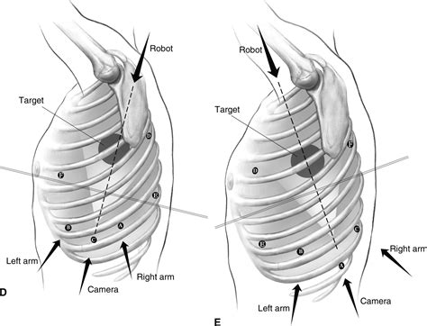 Robotic Lobectomy Operative Techniques In Thoracic And Cardiovascular Surgery