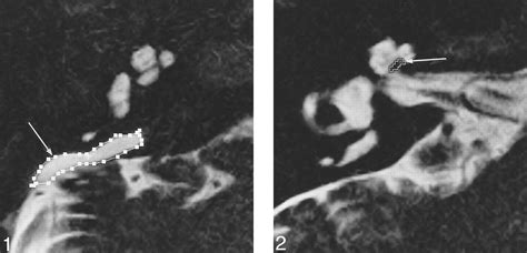 Endolymphatic Sac Mri