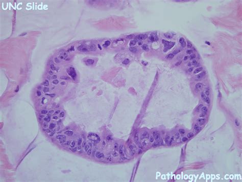 mucinous adenocarcinoma pathology