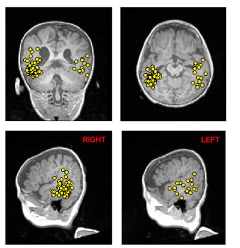 Magnetoencephalography (MEG Scan) - The Defeating Epilepsy Foundation