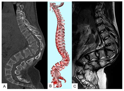 Medicina Free Full Text Long Term Results Of Posterior Vertebral Column Resection For Severe