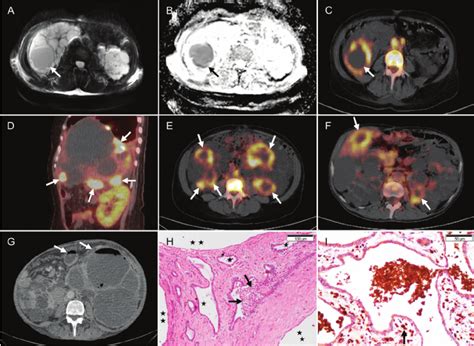 Cyst Infection In Autosomal Dominant Polycystic Kidney Download