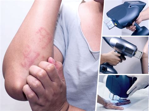 Excimer Laser Treatment For Eczema Genzbeau