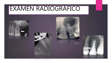 Diagnóstico de patologías pulpares y periapicales PPT