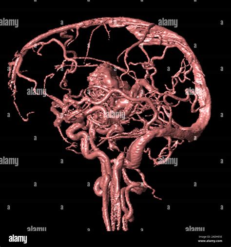 Brain Arteriovenous Malformation Image Of Coloured Magnetic